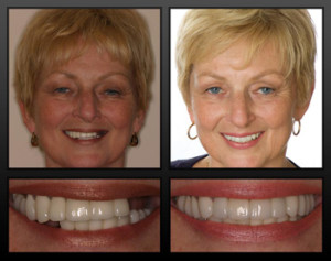 Implants