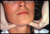OralCancerFaceHigh