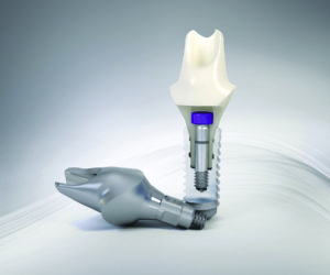 dental-implants-brantford